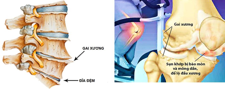 Thoái hóa cột sống là gì? Những yếu tố gì có thể gây ra tình trạng thoái hóa cột sống?