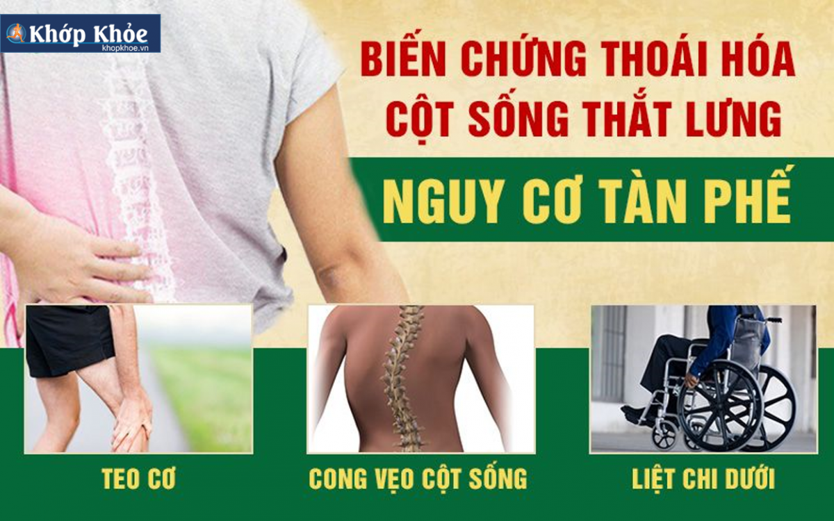 Thoái hóa cột sống thắt lưng