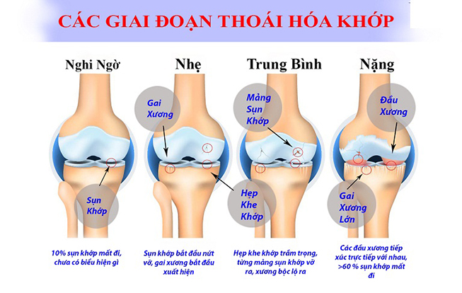 4 giai đoạn thoái hoá khớp gối