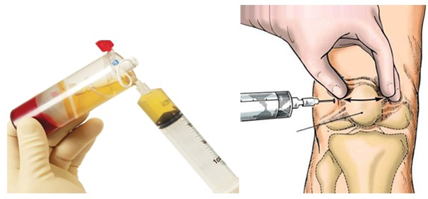 Dấu hiệu Thoái hóa khớp gối