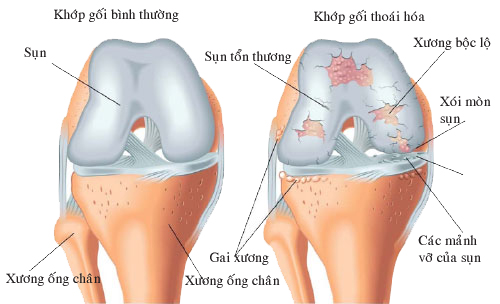 thoái hoá khớp