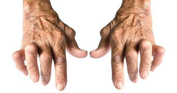 Viêm khớp dạng thấp là gì