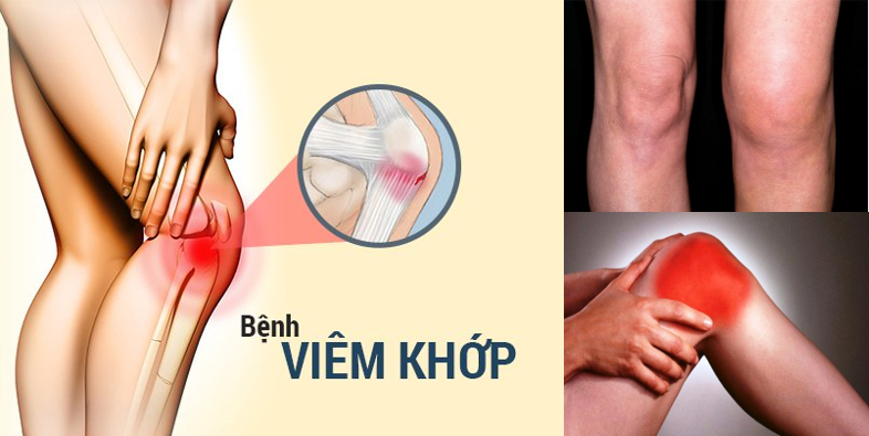 4 Dấu hiệu dễ nhận biết Viêm khớp
