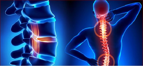 Đau lưng có phải là bị thoái hóa thắt lưng không, làm thế nào để biết được mình bị thoái hóa thắt lưng?