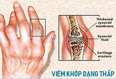 Dấu hiệu Bệnh viêm khớp dạng thấp