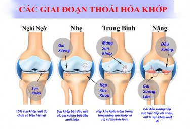 thoái hoá khớp gối