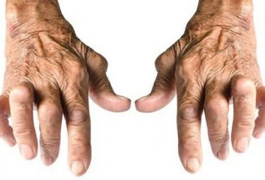 Viêm khớp dạng thấp là gì