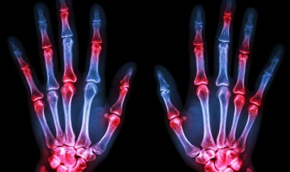 Dấu hiệu Bệnh viêm khớp dạng thấp