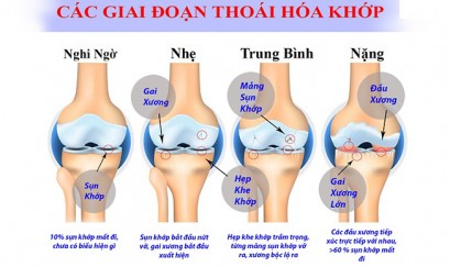 thoái hoá khớp gối